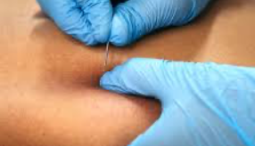 Trigger Points — Dry Needling